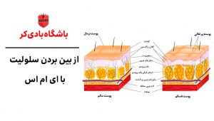 از بین بردن سلولیت با ای ام اس